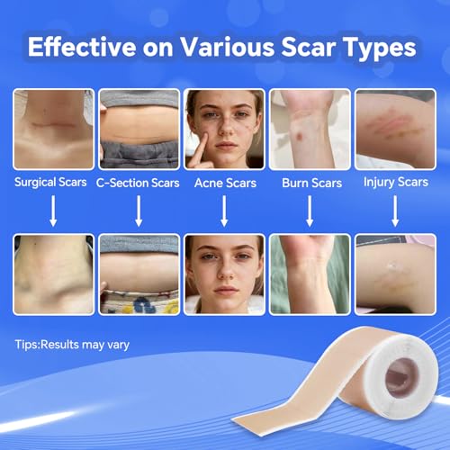 Professional Silicone Scar Sheets, Silicone Scar Tape, Silicone Scar Patch, Reusable Scar Silicone Strips (1.5M)