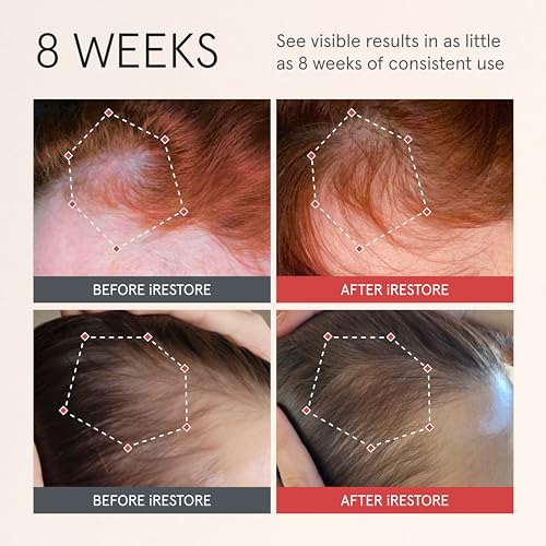 iRESTORE Hair Growth Serum for Women & Men | 2 Fl Oz, Pack of 3