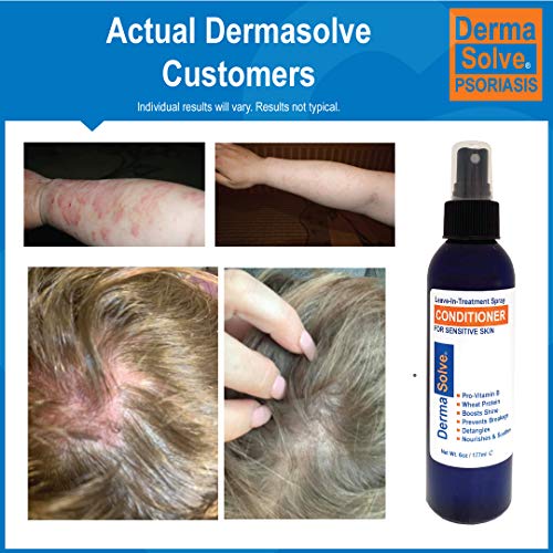 Dermasolve Psoriasis Leave-In Conditioner Spray for Sensitive Scalp