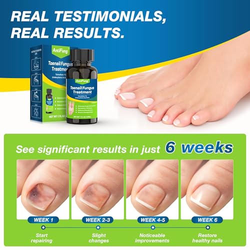 Extra Strength Toenail Fungus Treatment with 25% Undecylenic Acid - 30ml