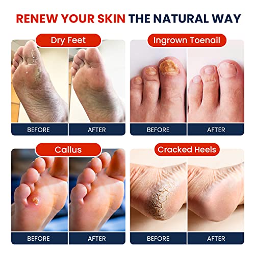 Muscle Relief Foot Soak with Epsom Salts & Tea Tree Oil Foot Balm - Moisturizing Athletes Foot Care Balm for Dry Cracked Feet