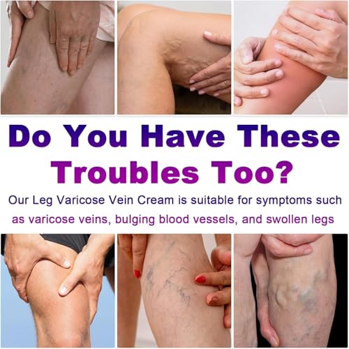 Varicose Veins Cream for Legs - Arnica & Aloe Vera 2-Pack