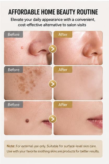 6-in-1 Plasma Pen Skin Tag Remover - 10 Intensity Levels