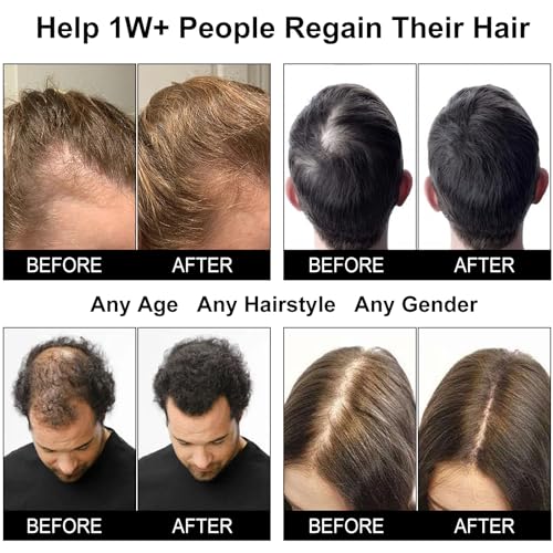 CWTUL Laser Hair Growth Cap with Red & Blue Light Therapy for Hair Regrowth