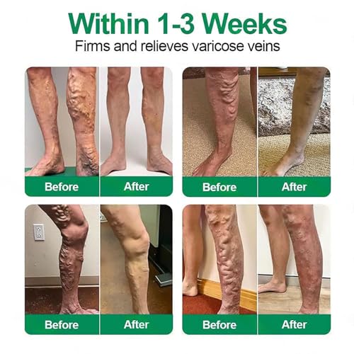 Varicose Veins Patch for Legs - Relief & Skin Smoothing (4 Pack)