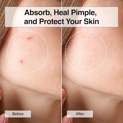 FreeGo XOXO Hydrocolloid Pimple Patch, 120 Counts | Cute Colorful Heart Shape | Salicylic Acid, Niacinamide, CICA, Tea Tree, Eucalyptus | Absorb, Heal Pimple and Protect Skin | Made in Korea