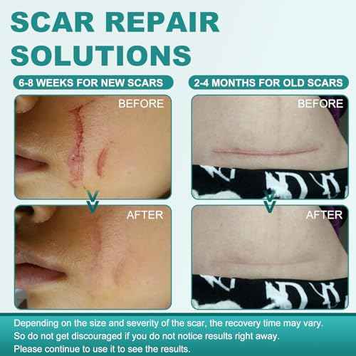 Silicone Scar Sheets, Silicone Scar Tape(1.6"x 158"), Scar Tape for Scar Removal Treatment, Reusable Silicone Scar Strips for Surgical, C-Section, Keloid, Burn, Acne, Surgical Scars
