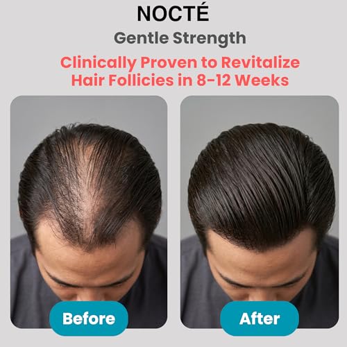 NOCTE 2% Minoxidil Hair Regrowth Serum Spray with Biotin & Caffeine for Thicker Hair