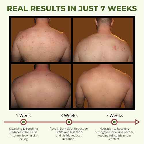 ABERA High-Performance Folliculitis Body Wash with Wild Bitter Melon Extract, BHA Shower Gel, Reduces Back Acne & Keratosis Pilaris, Folliculitis Treatment, Acne Body Wash for Sensitive Skin, 10.14 oz