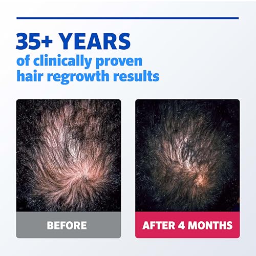 Rogaine Extra Strength 5% Minoxidil Hair Regrowth Solution for Men