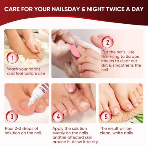 Toenail Treatment,Gentle Formula, Effectively Improves Nails for a