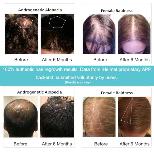 iHelmet Laser Hair Growth System - FDA Cleared Red Light Therapy Helmet for Hair Regrowth