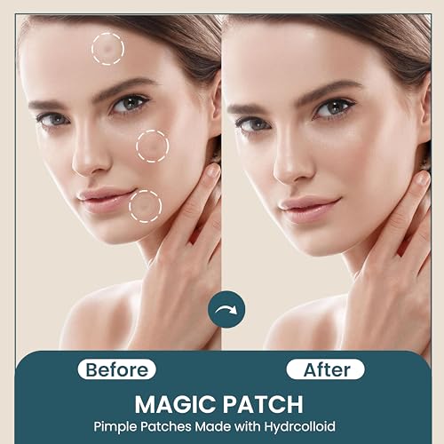MAGIC PATCH - Pimple Patches - Invisible Fast-Acting Acne Spot Care for Face & Body - Skin Care Patch for Treating Pimples, Blackheads & Zits - Vegan Hydrocolloid - 60 Pore Patches - By SPLURJ