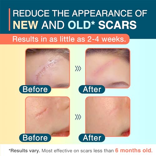 Silicone Scar Sheets, 1.55¡± x 156¡± - 4M, Medical Silicone Scar Tape Roll, Reusable Scar Strips for Surgical, C-Section, Keloid Bump, Stretch Marks, Acne, Hypertrophic Scar Treatment