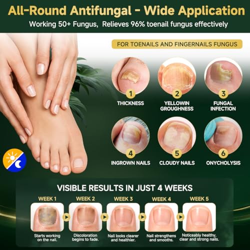 Nerante Toenail Fungus Treatment Pen Set - 6 Pens with 25% Undecylenic Acid