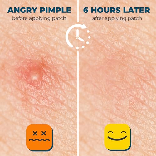 Acne Pimple Patches For Face - Clear Hydrocolloid Acne Patch Zit Stickers - Pimple Patches Salicylic Acid & Tea Tree Oil - Invisible Dots Spots For Sensitive Skin Blemish & Pimples Parches (300 Pack)
