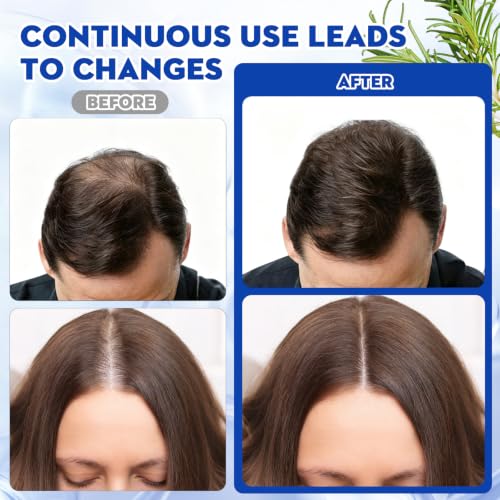 Hair Growth Serum Roll-On (2 Pack) - 3% Redensyl, Biotin & Rosemary Oil
