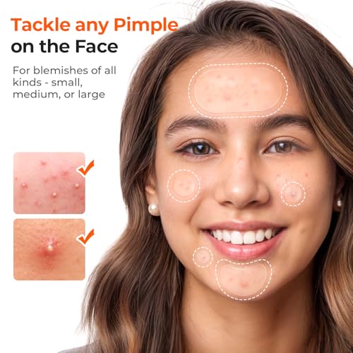 TKTK 443 Hydrocolloid Acne Patches, 5 Sizes Pimple Stickers