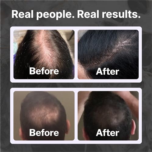Shapiro MD Hair Loss Shampoo | DHT Fighting Formula for Thicker Hair
