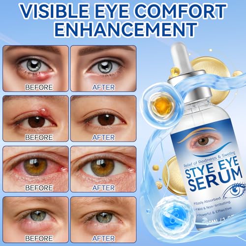Stye Eye Treatment Serum 30ml - Natural Relief for Styes & Blepharitis