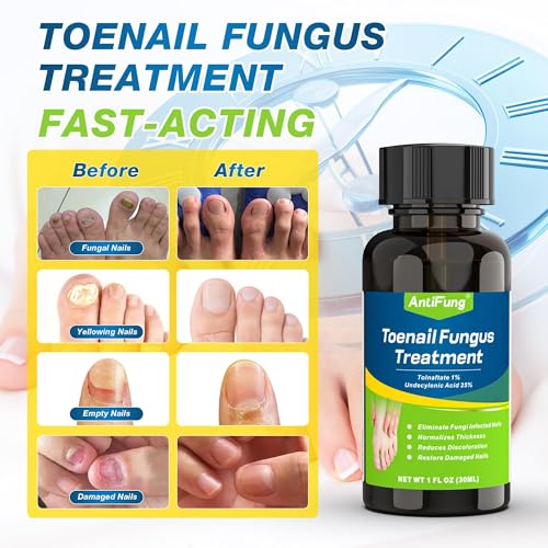 Extra Strength Toenail Fungus Treatment with 25% Undecylenic Acid - 30ml