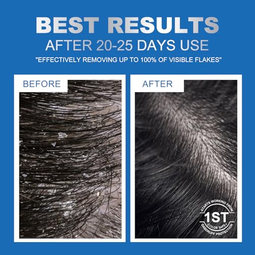 Ceson&Cesun Anti-Fungal 2-in-1 Shampoo for Scalp Relief