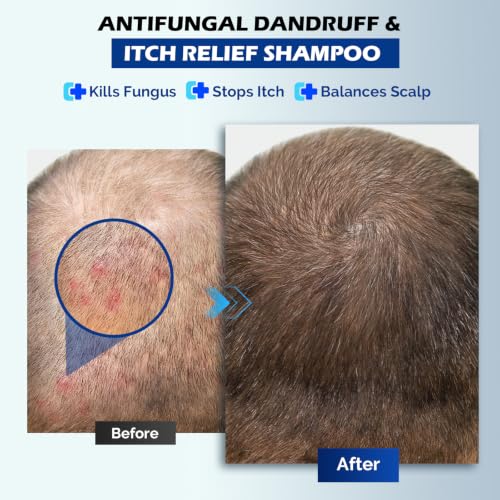 Oely Antifungal Shampoo Fresh for Seborrheic Dermatitis & Folliculitis - Root Care