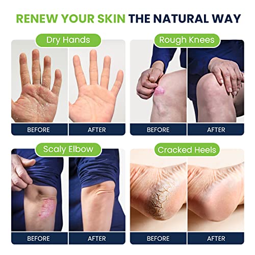 Citrus Detox Foot Soak with Epsom Salts - for Foot Callus, Tea Tree Oil Foot Cream - Moisturizing Athletes Foot Care For Dry Cracked Feet Cream - Heel & Callus Removal