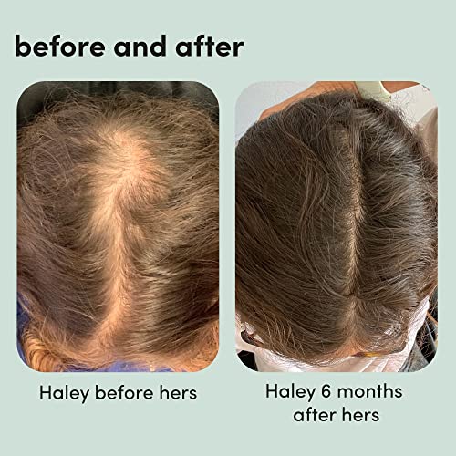 hers Hair Regrowth Treatment for Women with 2% Topical Minoxidil Solution for Hair Loss and Thinning Hair, Unscented, 2 Month Supply, 2 Pack