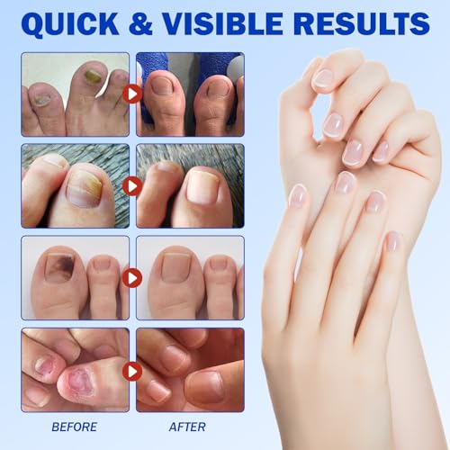 Fungal Nail Patches for Toenails – 21 Pack Hydrogel Treatment