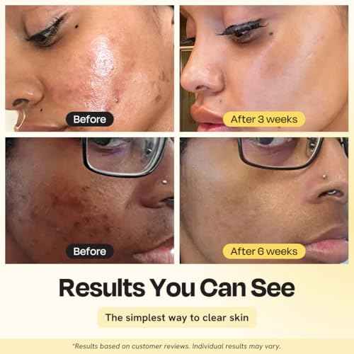 Gleamin Vitamin C Clay Mask for Dark Spots, Turmeric Clay Face Mask Skin Care, Deeply Cleanses & Refines Pores, Brightens Uneven Tone and Helps Improve Post-Blemish Scarring & Texture - 5 Oz