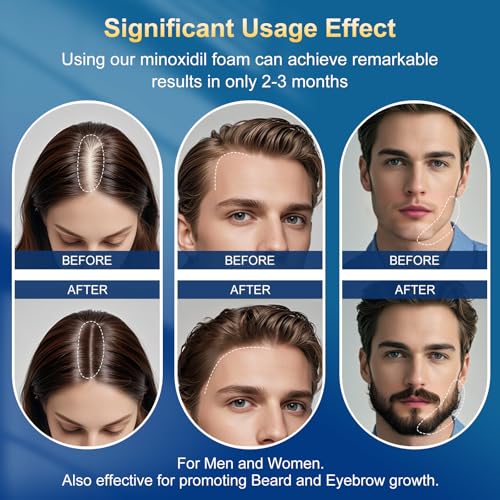 Minoxidil Foam for Men - Hair Regrowth Treatment with Biotin, 5% Strength, 5 Pack