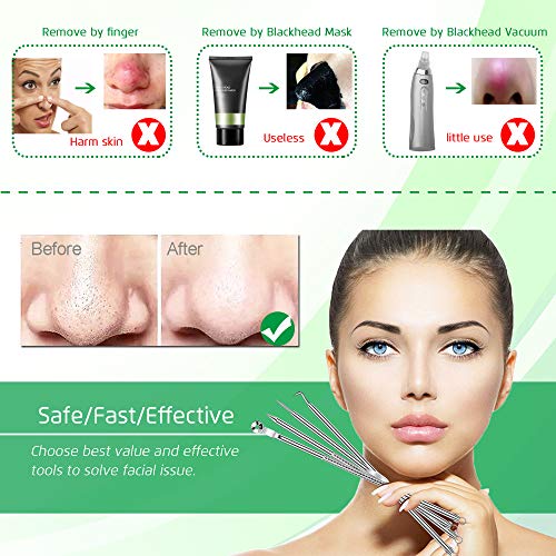 5-Piece Blackhead Remover Kit, Professional Stainless Steel Comedone Extractors