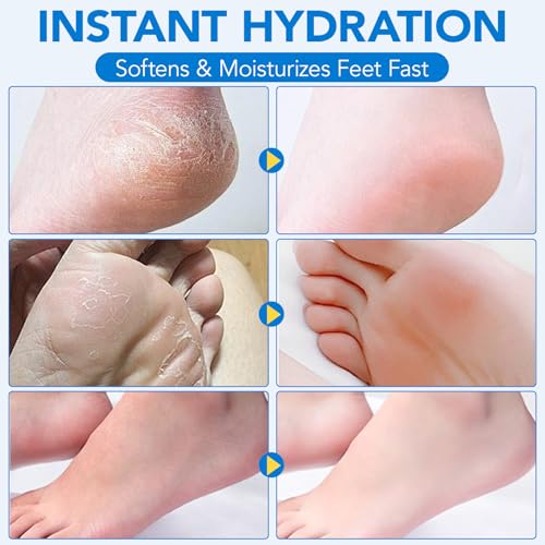 Uruses 3-Pack Urea Cream 60% with Salicylic Acid for Callus Remover