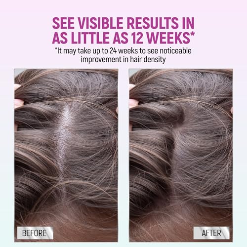 Minoxidil 5% Foam for Women Hair Regrowth, 2.11 Oz