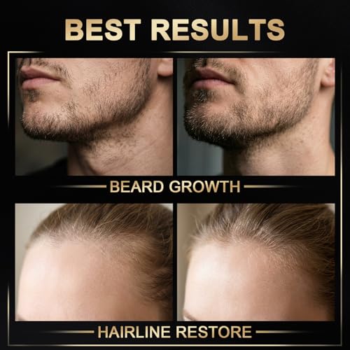 5% Minoxidil Hair Growth Spray with Biotin & Rosemary - 3.38 Fl Oz