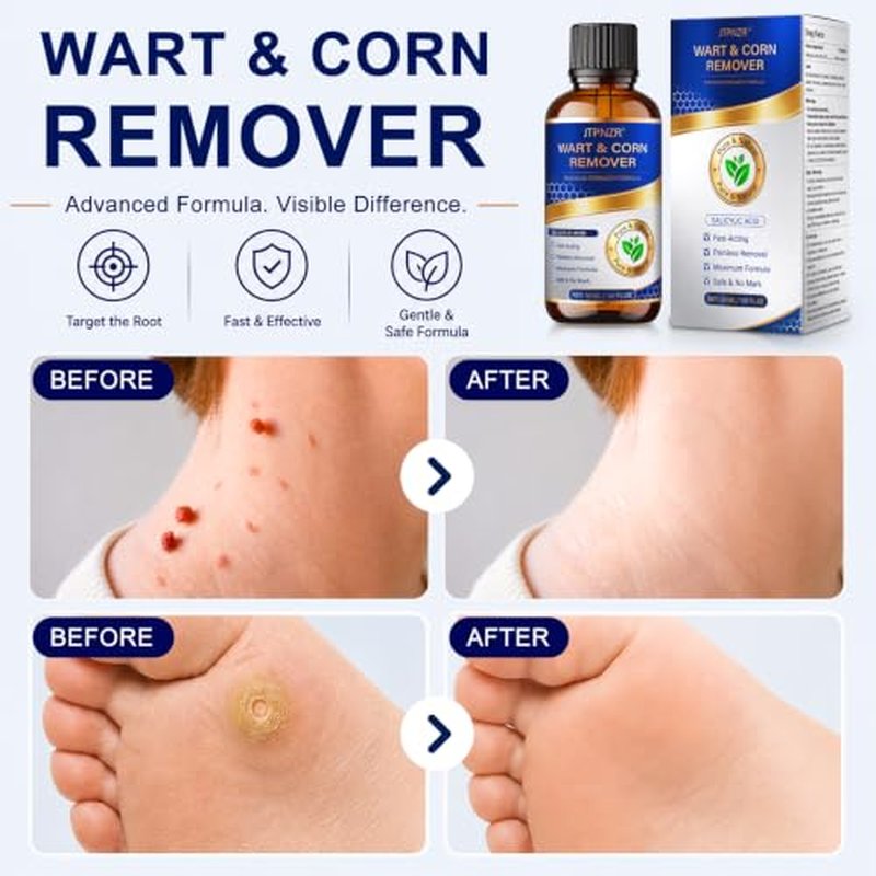 20% Salicylic Acid Skin Tag & Wart Remover - 30ml Kit