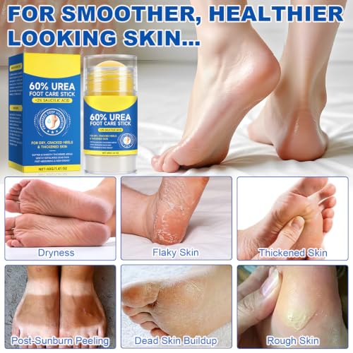 ConfidMiss 60% Urea Foot Care Stick for Cracked Heels & Calluses (2 Pack)