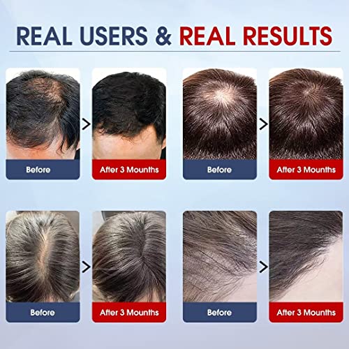 Laser Hair Growth Cap 180 Lasers, Hair Loss Treatments For Men and Women, Hair Regrowth Helmet For Thinning Hair, Low Level Laser Therapy Hair Growth Products