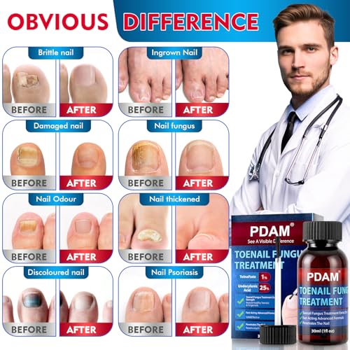 Toenail Fungus Treatment - 25% Undecylenic Acid Maximum Strength