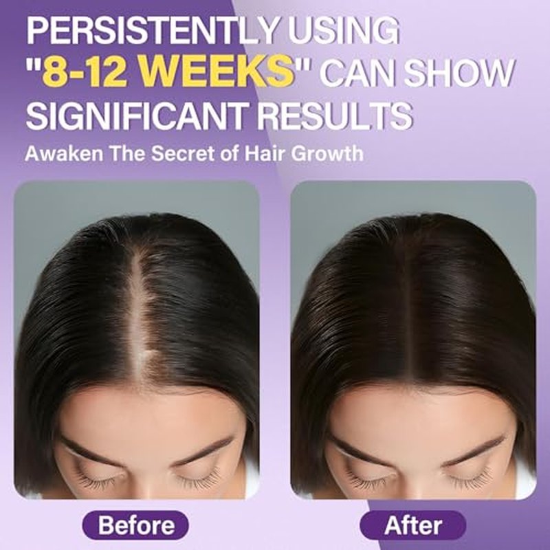 5% Minoxidil Foam for Women Hair Growth - 3 Pack