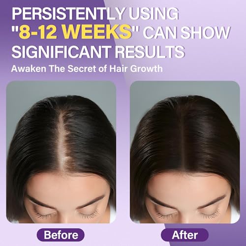 5% Minoxidil Foam for Women - Hair Growth Treatment for Thinning Hair