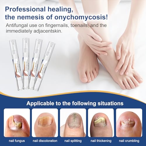 Drawzone Extra Strength Toenail Fungal Treatment Pen 4 Pack - 25% Undecylenic Acid, Ingrown Nail Care