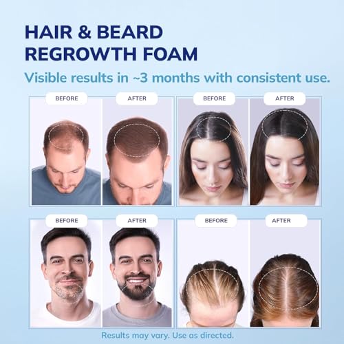 RootStim 5% Minoxidil Foam for Men & Women Hair Loss Treatment, Thicker Fuller Hair, 6 Fl Oz