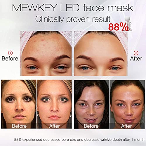 NEWKEY Blue Light Therapy Mask for Acne - Full Face LED Treatment