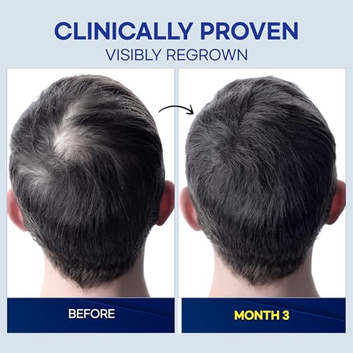 ProBliva 5% Minoxidil Hair Growth Spray for Men - 2 FL OZ