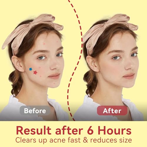 Star Pimple Patches for Face - 6 Colors 198Pcs (14mm) Hydrocolloid Acne Patches, Day & Night Blemish/Zit Healing Pimple Patches (66count-Pack of 3)