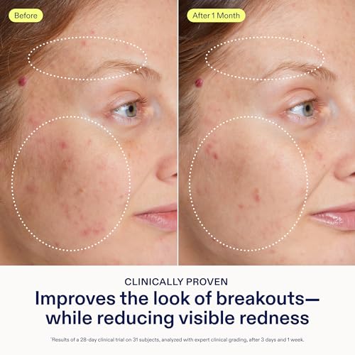Skinfix Adapinoid Gel - 1 oz - Retinoid Serum for Acne-Prone Skin with Niacinamide - Visibly Reduces Redness & Improves Look of Breakouts and Pores - Fragrance Free - Vegan, Cruelty Free