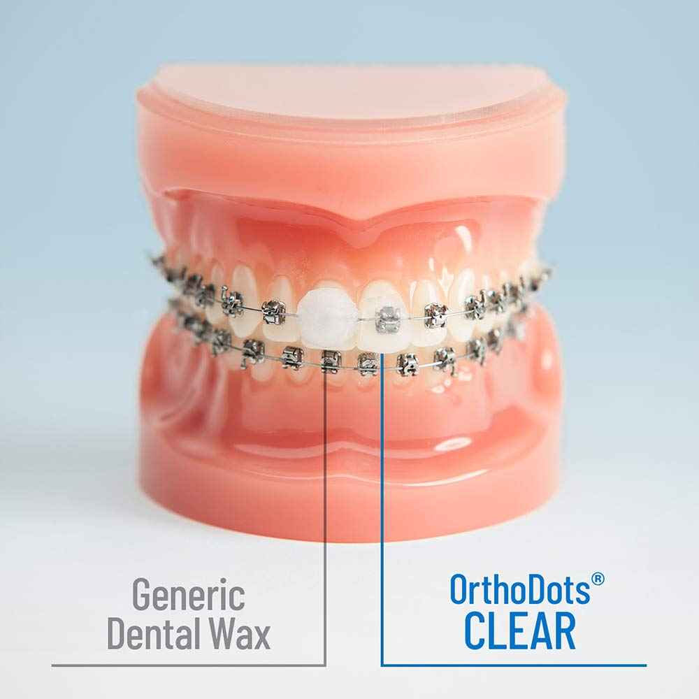 OrthoDots Clear – 24-Hour Protection | Sticks Better Than Dental Wax | Moisture Activated Braces Wax Alternative for Pain Caused by Braces, Clear Aligner Trays, and Other Orthodontic Appliances