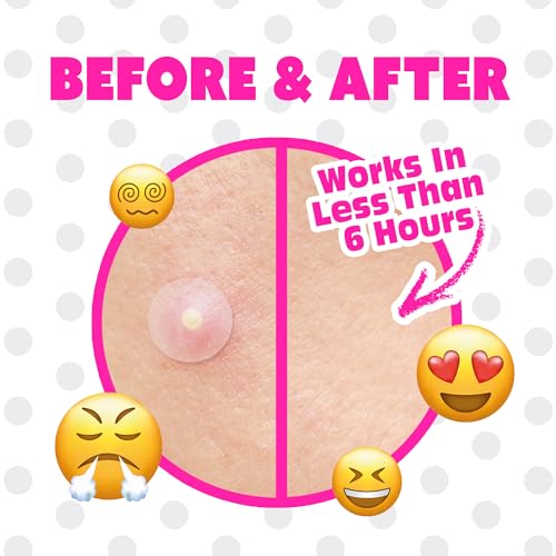 EBIN NEW YORK Pimple Patches for Face Original- Hydrocolloid Acne Patches for Blemishes & Breakouts and Absorbing Zits, Recover the Spot Quickly, Cover Spot from Dirt, Invisible Finished